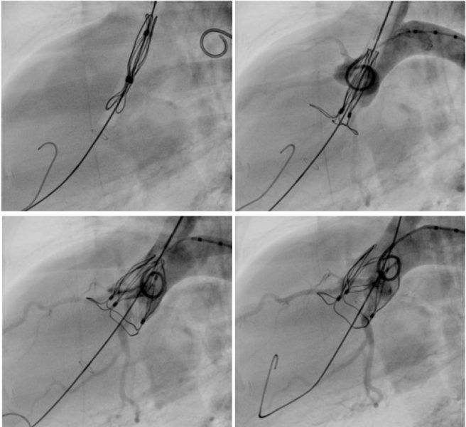 TRISKELE - UCL Transcatheter Aortic Valve - UCL Cardiovascular ...