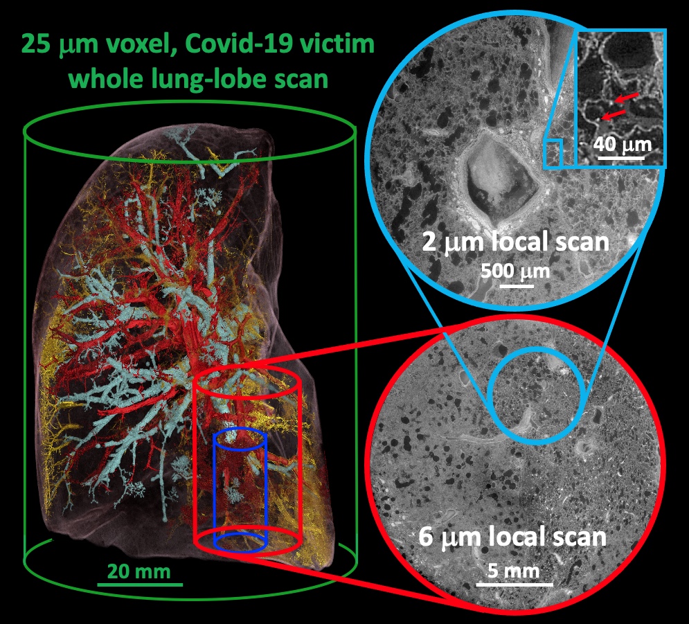 HiP-CT characterisation of the damage in a Covid-19 injured lung lobe zoom from the whole organ down to 2 micron resolution.