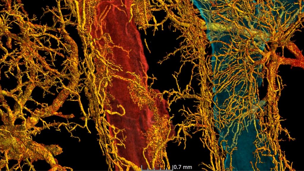 Bronchio-pulmonary shunting in a SARS-CoV-2 infected lung