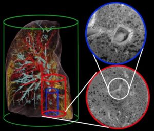 HiP-CT characterisation of the damage in a Covid-19 injured lung lobe zoom from the whole organ down to 2 micron resolution.