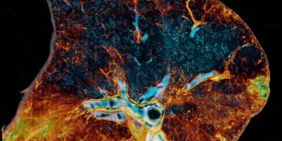 Image of a COVID-19-injured lung where blue represents open airways.